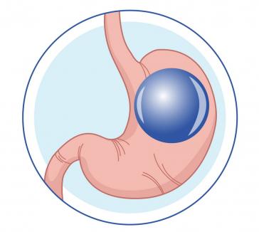 În premieră în Oradea, Centrul Vascular Venus vă oferă o nouă tehnică minim invazivă utilizată pentru tratamentul obezității: balonul intragastric Heliosphere