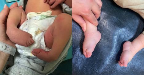 Premieră pentru Bihor în ortopedia pediatrică: corectarea unui picior strâmb ca o „copită” la o fetiță de 6 ani