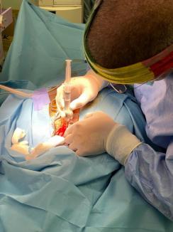 Intervenție neurochirugicală în premieră la Oradea, a doua în România, pentru eliminarea durerilor după operații multiple pe coloana vertebrală (FOTO)