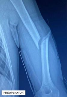 Operație în premieră la Oradea: Unui adolescent i s-a fixat un os fracturat cu o tijă de titan (FOTO)