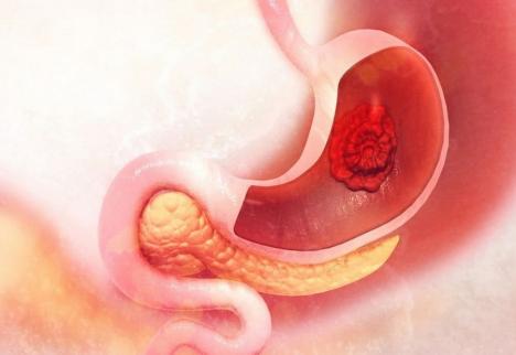 Ulcerul duodenal: Care sunt factorii de risc