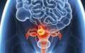 Cancerul de col uterin şi infecţia cu HPV