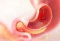 Ulcerul duodenal: Care sunt factorii de risc