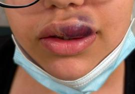 O adolescentă din Oradea era să-și piardă o parte din buză, după o injecție cu acid hialuronic într-un salon clandestin. Autoarea, căutată de Poliție