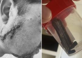 A ajuns la spital cu o așchie în obraz și ar fi fost cusut cu lemnul în rană de un... ginecolog