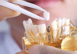 Implantul dentar. Ce este şi când se foloseşte