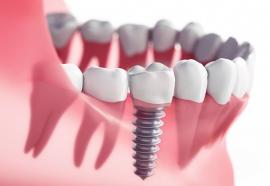 Implantul dentar: Ce se întâmplă când implantul e necesar, dar pacientul nu are suficient os pentru aplicarea lui