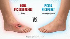 O șansă la vindecare pentru pacienții cu picior diabetic: terapie hiperbară gratuită printr-un nou program