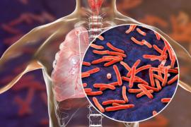 Tuberculoza: De câte forme este, cum se previne și cum se tratează?